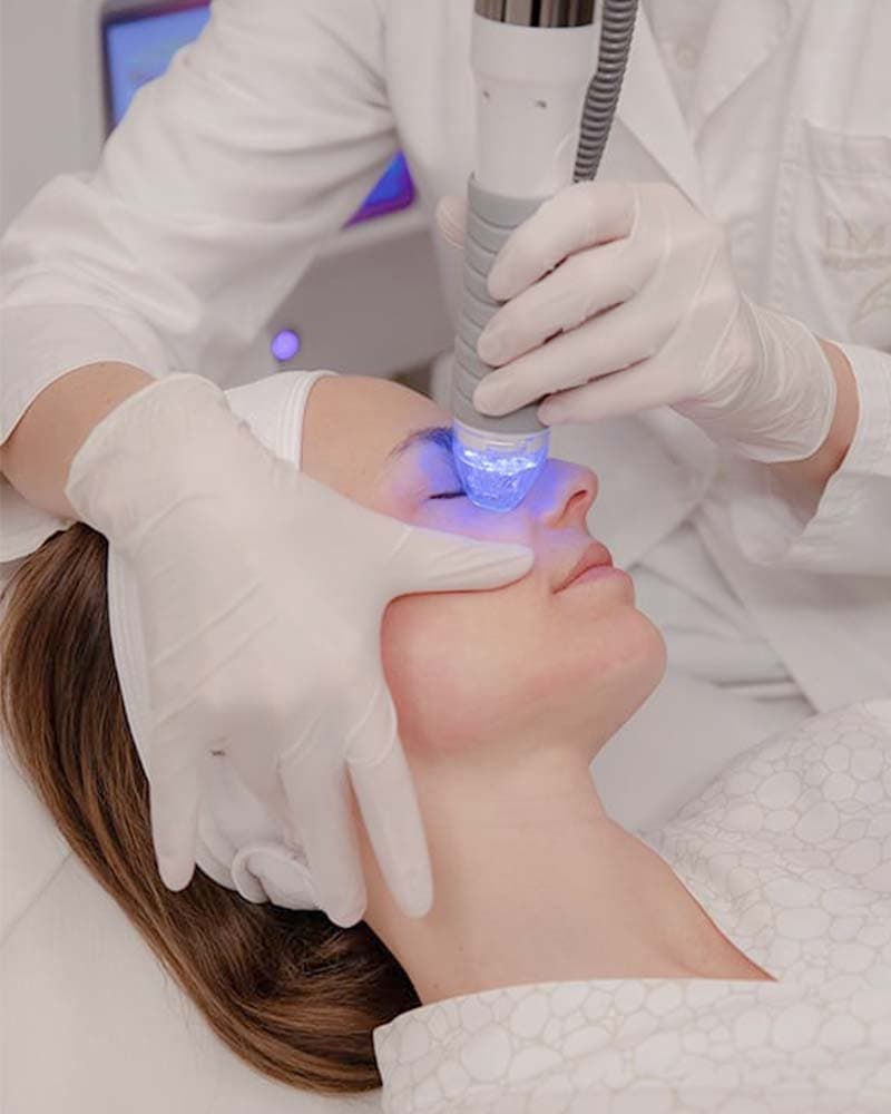 Microneedling