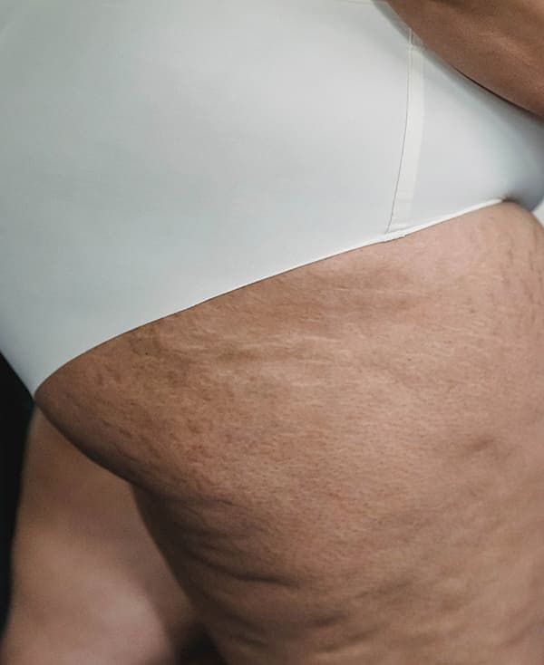 Cellulite Reduction