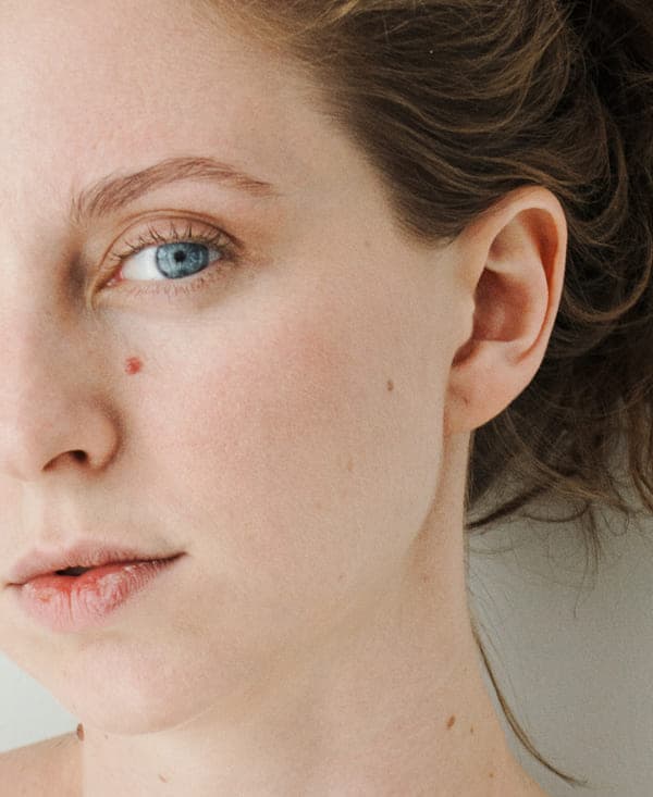 Red moles 