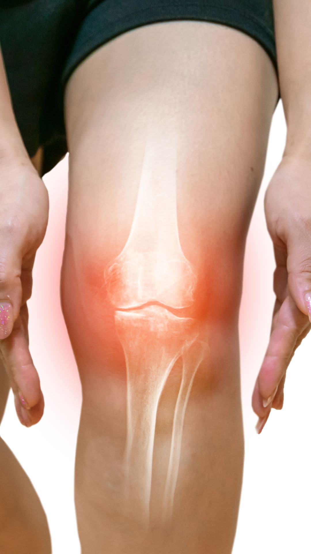 Osteoarthritis: How is it Treated with Regenerative Medicine?