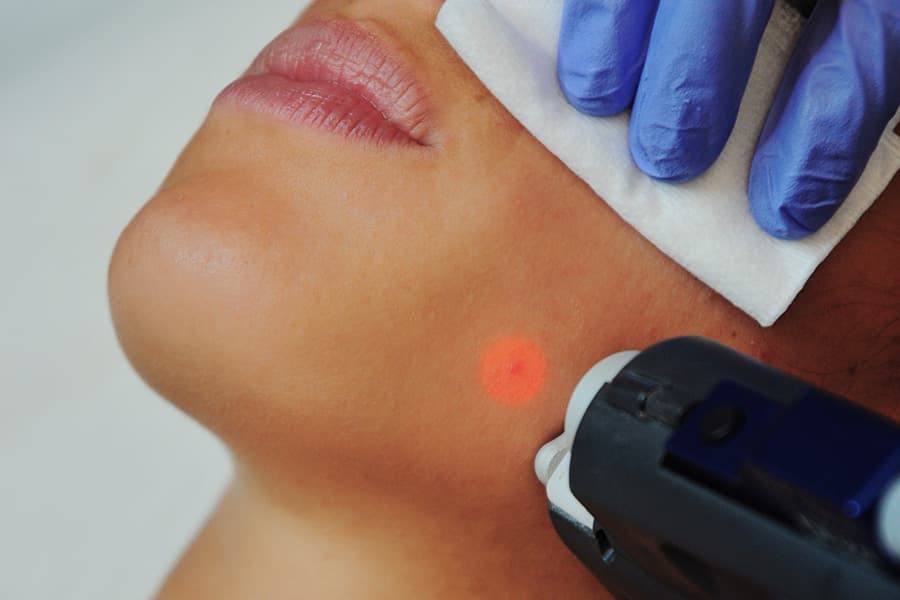 Melasma and Dark Spots: Removal Has Never Been Easier