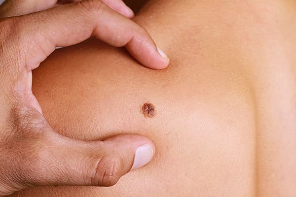 Skin Moles: 7 Common Myths Debunked