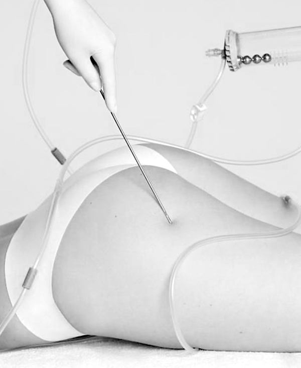 Case Study: Lipoaspiration vs Liposuction - Understanding the Difference
