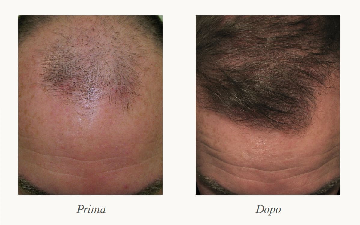 Regenerative Hair Transplant