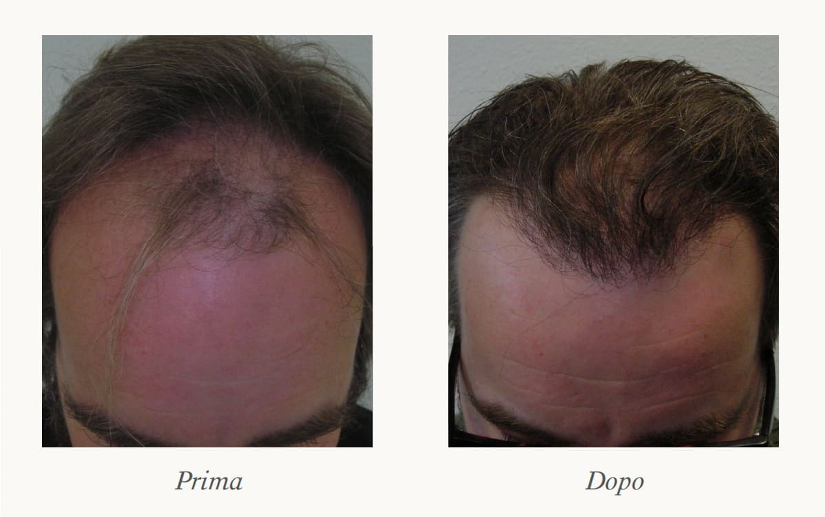 Regenerative Hair Transplant