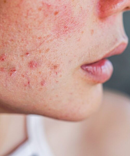 Acne scars: Lipogems and CO2 laser, the results of a study by Image Regenerative Clinic